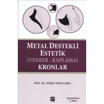 Metal Destekli Estetik (Veneer-Kaplama)Kronlar