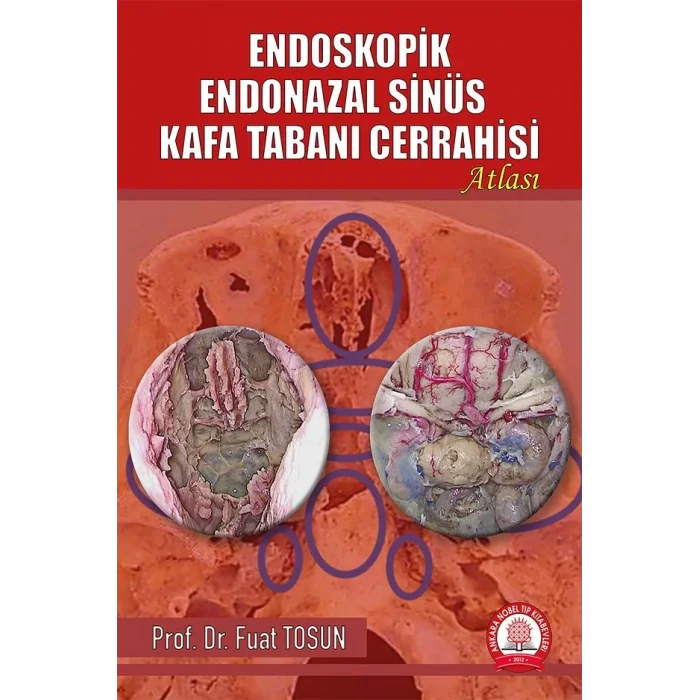 Endoskopik Endonazal Sinüs Kafa Tabanı Cerrahisi