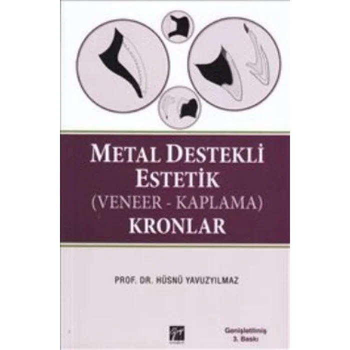 Metal Destekli Estetik (Veneer-Kaplama)Kronlar