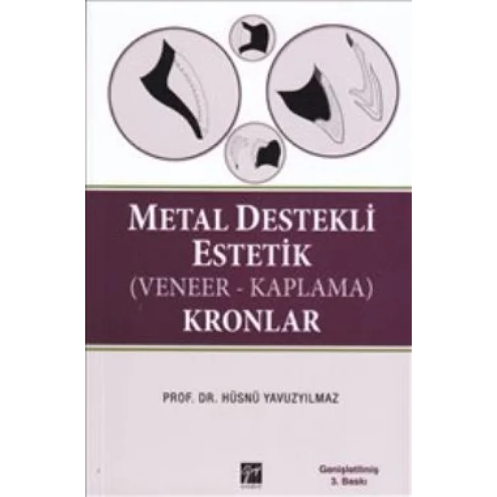 Metal Destekli Estetik (Veneer-Kaplama)Kronlar