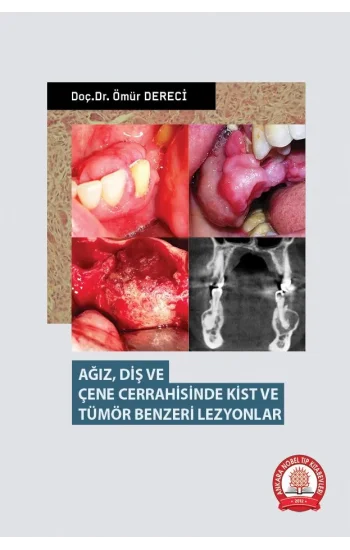 Ağız Diş ve Çene Cerrahisinde Kist ve Tümör Benzeri Lezyonlar