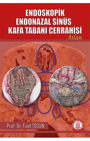 Endoskopik Endonazal Sinüs Kafa Tabanı Cerrahisi