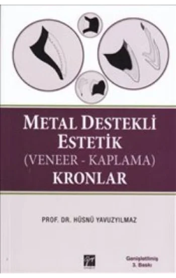 Metal Destekli Estetik (Veneer-Kaplama)Kronlar