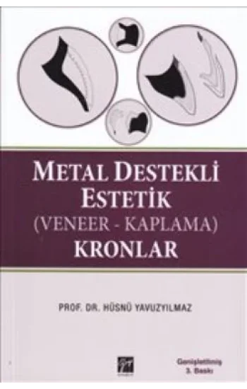 Metal Destekli Estetik (Veneer-Kaplama)Kronlar