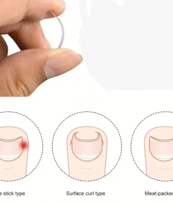 Baş Parmak Tırnak Batmasını Engelleyen Metal Aparat Nrd 603 *