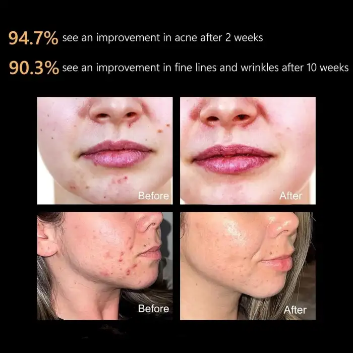 Aphrona Moonlight 3 Renkli LED Yüz ve Cilt Bakım Maskesi - Işık Terapisi