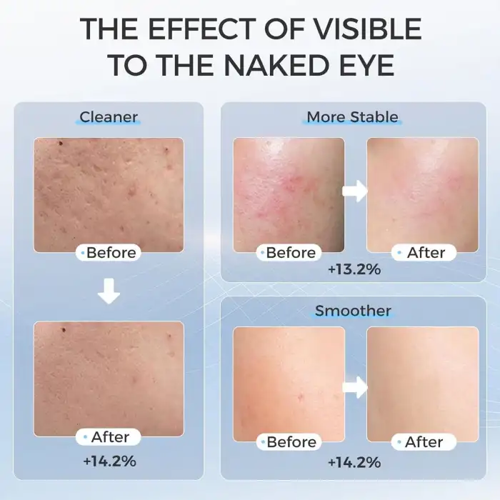 EVFOFO Yüz için Kırmızı ve Mavi Kırmızı Işık Terapi Maskesi