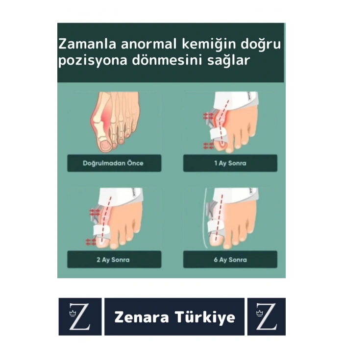 Premium Sağ Sol Her İki Ayak İçin Uyumlu Yıkanıp Kolay Temizlenir Baş Parmak Kemik Düzeltici Atel