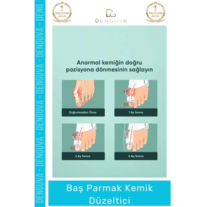 #ParmakDüzeltici Ortopedik Hallux Valgus Gece Gündüz Ateli Ayak Sağlığı Parmak Kemik Düzeltici 1 - Adet