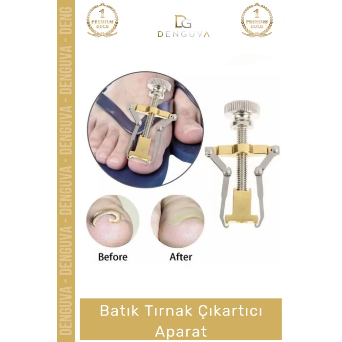 #TırnakBakım Batık Tırnak Düzeltici Profesyonel Ayak Sağlığı Bakım Düzeltme Çıkartıcı Pens Aparat