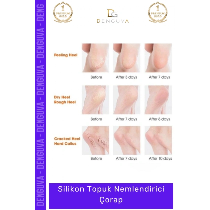 #TopukNemlendirici Silikon Jel Ayak Bakımı Çatlak Önleyici Koruyucu SPA Etkili Yumuşatıcı Topuk Nemlendirici