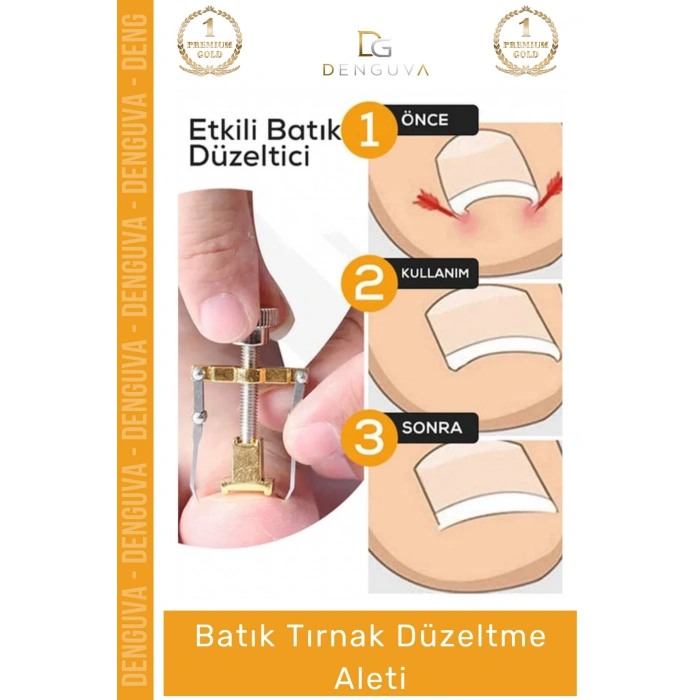#TırnakDüzeltici Profesyonel Ayak Bakım Aparatı Ev Tipi Etkili Tırnak Çıkartıcı Batık Tırnak Düzeltici