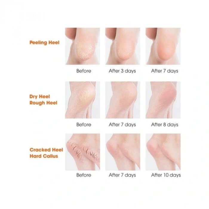 Nevamel Silikon Topuk Nemlendirici Çorap