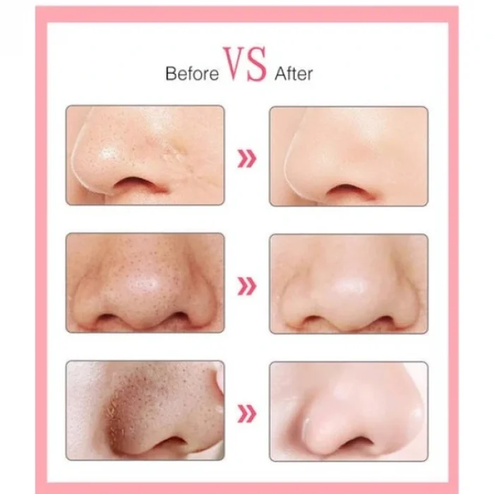 BUĞZ 6 Başlıklı Vakumlu Siyah Nokta Temizleyici