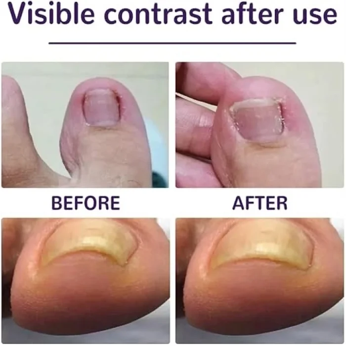 BUĞZ Ayak Tırnağı Düzeltme Bandı 50 Adet