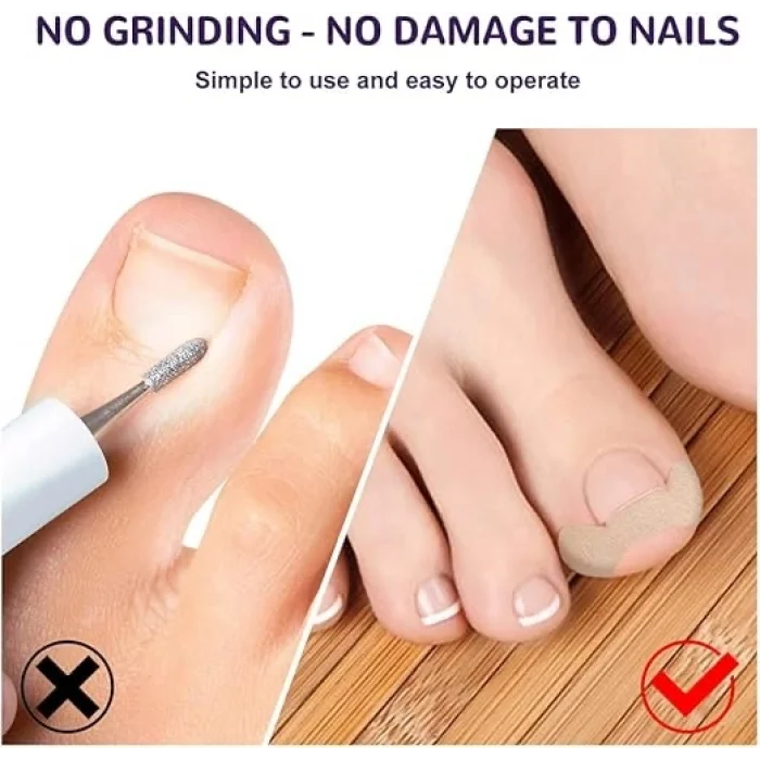 BUĞZ Ayak Tırnağı Düzeltme Bandı 50 Adet