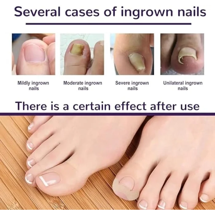 BUĞZ Ayak Tırnağı Düzeltme Bandı 50 Adet