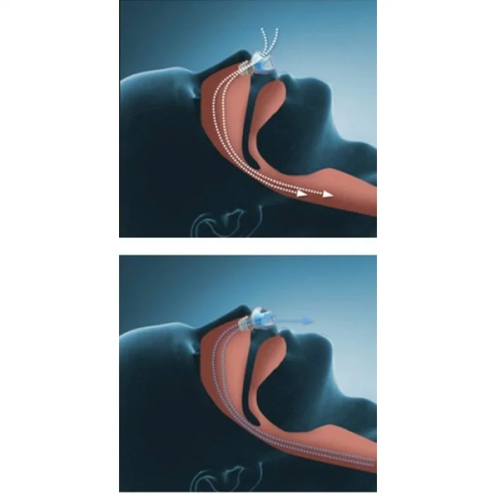 BUĞZ Horlama Önleyici Rahat Uyku Aparatı