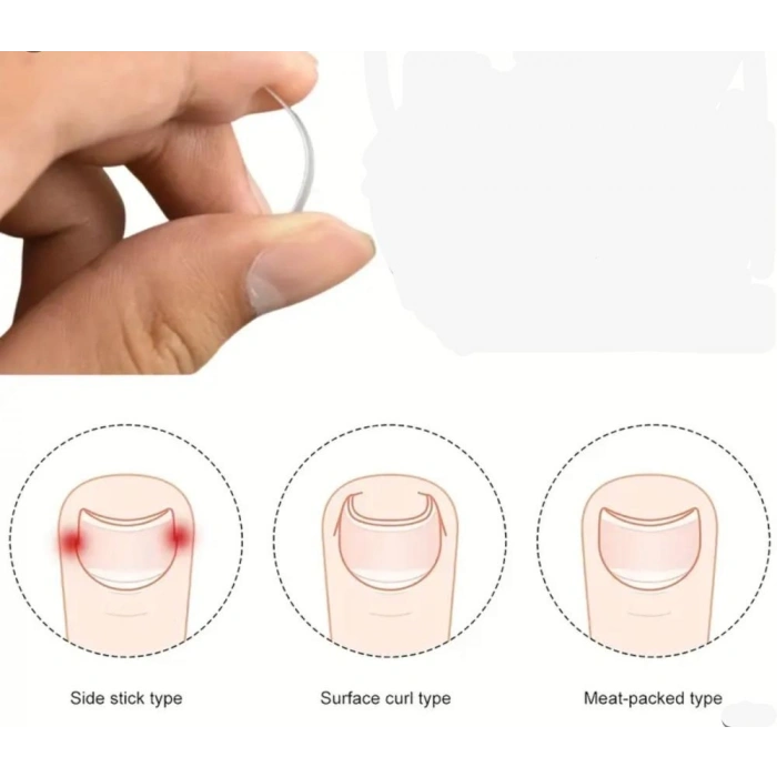 BAŞ PARMAK TIRNAK BATMASINI ENGELLEYEN METAL APARAT NRD 603 ***