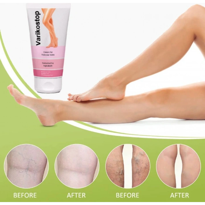 Varikostop Cream Yoğun Varisli Damarlar Için Effektif Krem