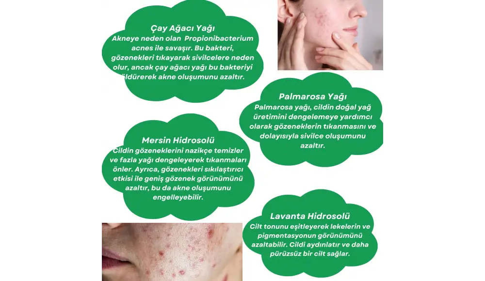 Akne ile Mücadelede Aromaterapi: Doğal ve Etkili Çözümler