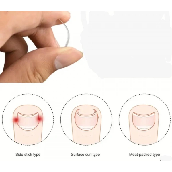 BAŞ PARMAK TIRNAK BATMASINI ENGELLEYEN METAL APARAT NRD 603 ***