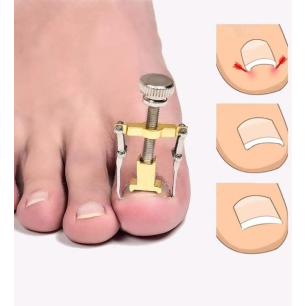 Batık Tırnak Çıkarma Aparatı