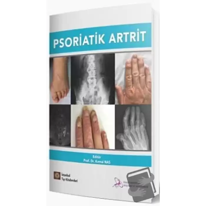 Psoriatik Artrit