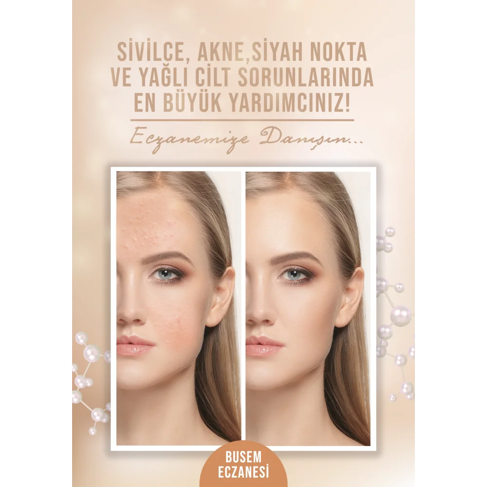 Sivilce Afiş & Poster