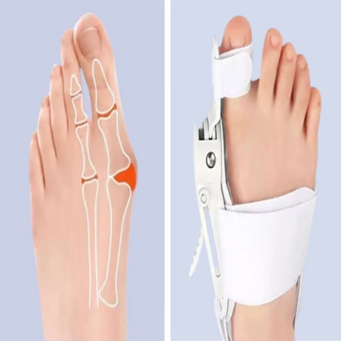 İpek Yıldızı® Ayarlanabilir Ayak Baş Parmak Kemik Düzeltici – Halluks Valgus (Bunyon) Aparatı, Gece Gündüz Kullanıma Uygun Ayak Düzeltme Ateli