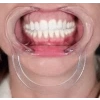 MOUL RETRACTOR