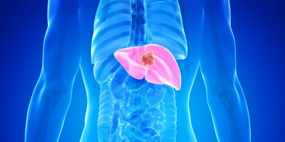 Karaciğer Kanseri Hakkında Merak Edilenler