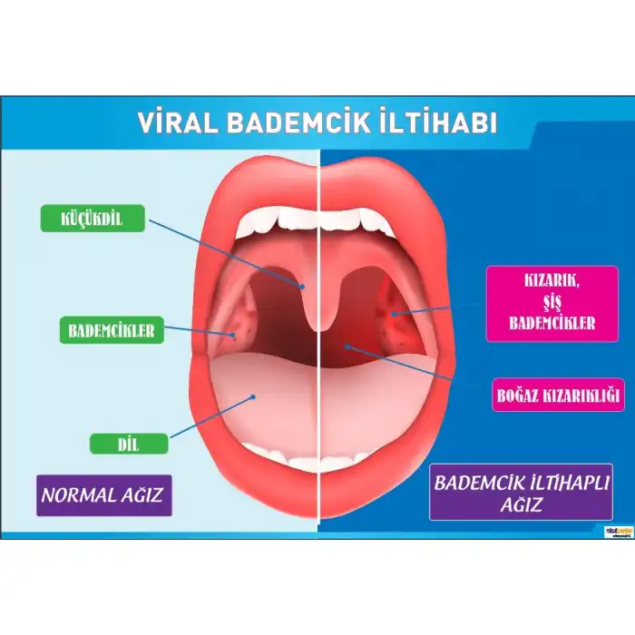 Bademcik İltihabı Afişi