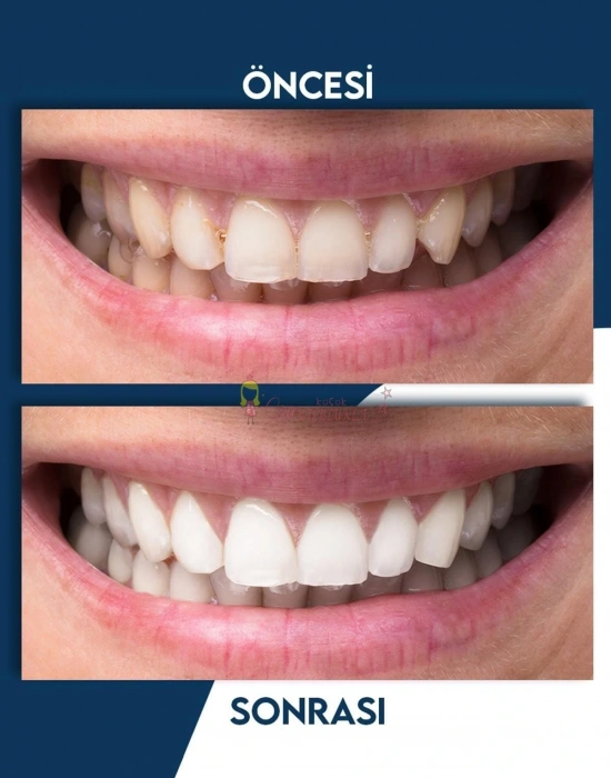 Mavi Işık Teknolojisi Ile Diş Beyazlatma Kiti & Beyazlatıcı Diş Kalemi Seti