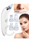 Pilli Derma Suction Vakumlu Siyah Nokta Yüz Temizleme Cihazı