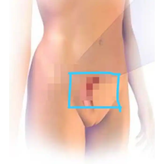 PELVİK Hint Yağı Sargı Bezi