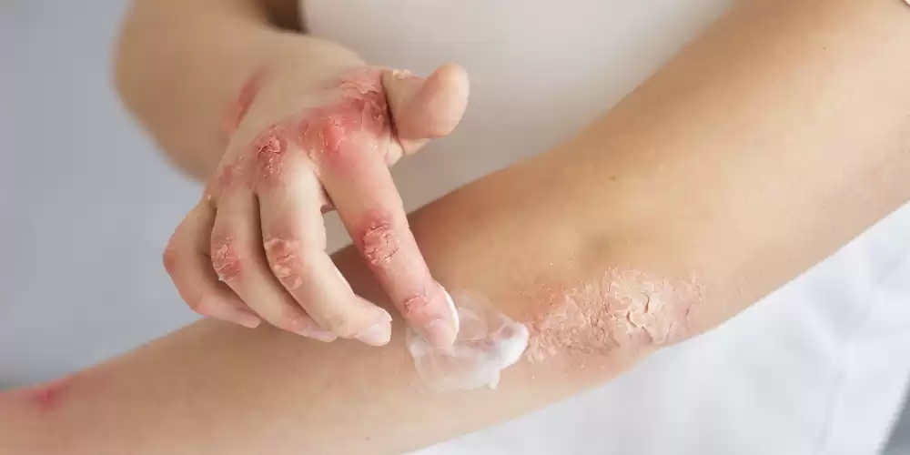 Egzama, Sedef ve Uyuz Merhemi Nedir? Faydaları ve Kullanımı