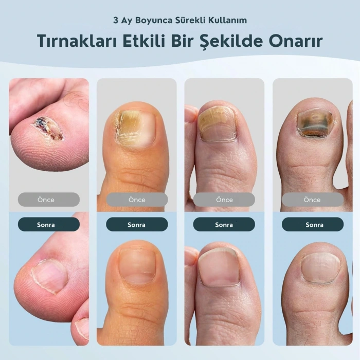 ShoptTech 36W Katlanabilir Tırnak Mantarı Işık Cihazı El ve Ayak Tırnağı İçin LED Fototerapi Lambası, USB Şarjlı