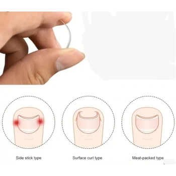 Baş Parmak Tırnak Batmasını Engelleyen Metal Aparat Nrd 603 *