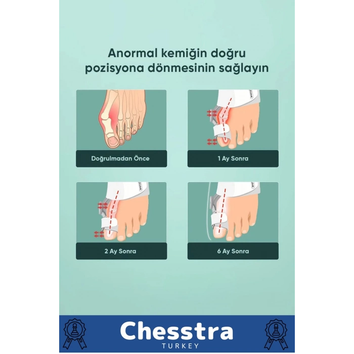 Yumuşak Yıkanabilir Bedensiz Koruma Aparat Sağ Sol Ayak Uyumlu Baş Parmak Kemik Düzeltici 6 Adet