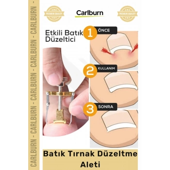 Özel Üretim Ayak Tırnağı Batma Ağrısı Giderici Evde Güvenli Kolay Bakım Batık Tırnak Düzeltici
