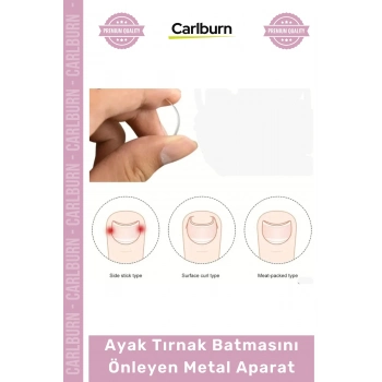 Özel Üretim Paslanmaz Çelik Ergonomik Tırnak Düzeltici Seti Ayak Tırnak Batmasını Önleyen Metal Aparat