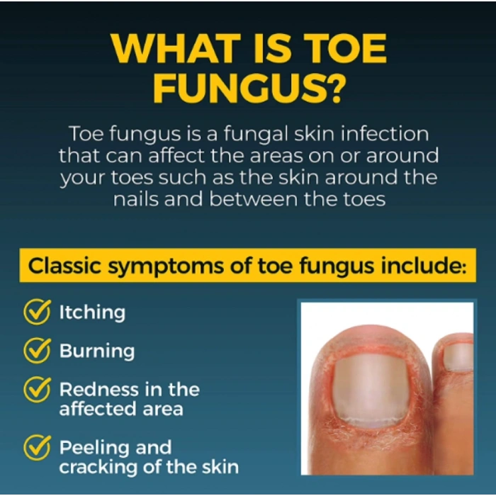 Fungı Naıl Antı-Fungal Sprey Clınıcally Proven To Cure and Prevent Infectıons Aloe & Tea Oil  30 ml