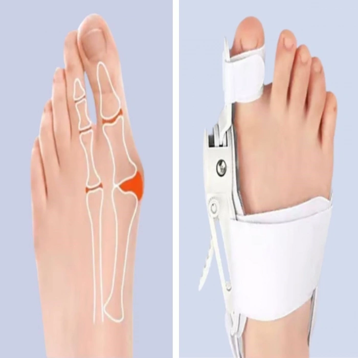 Ayarlanabilir Ayak Baş Parmak Kemik Düzeltici – Halluks Valgus (Bunyon) Aparatı, Gece Gündüz Kullanıma Uygun Ayak Düzeltme Ateli (5263)